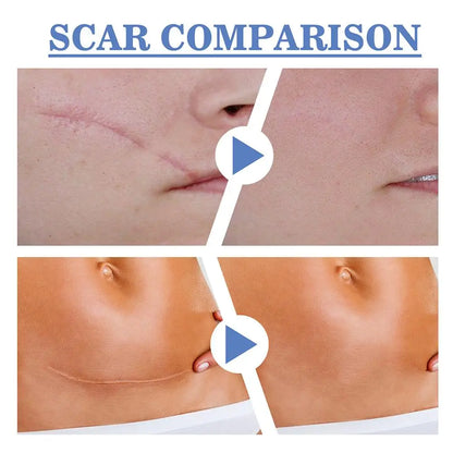 Silicone Scar Sheets ®